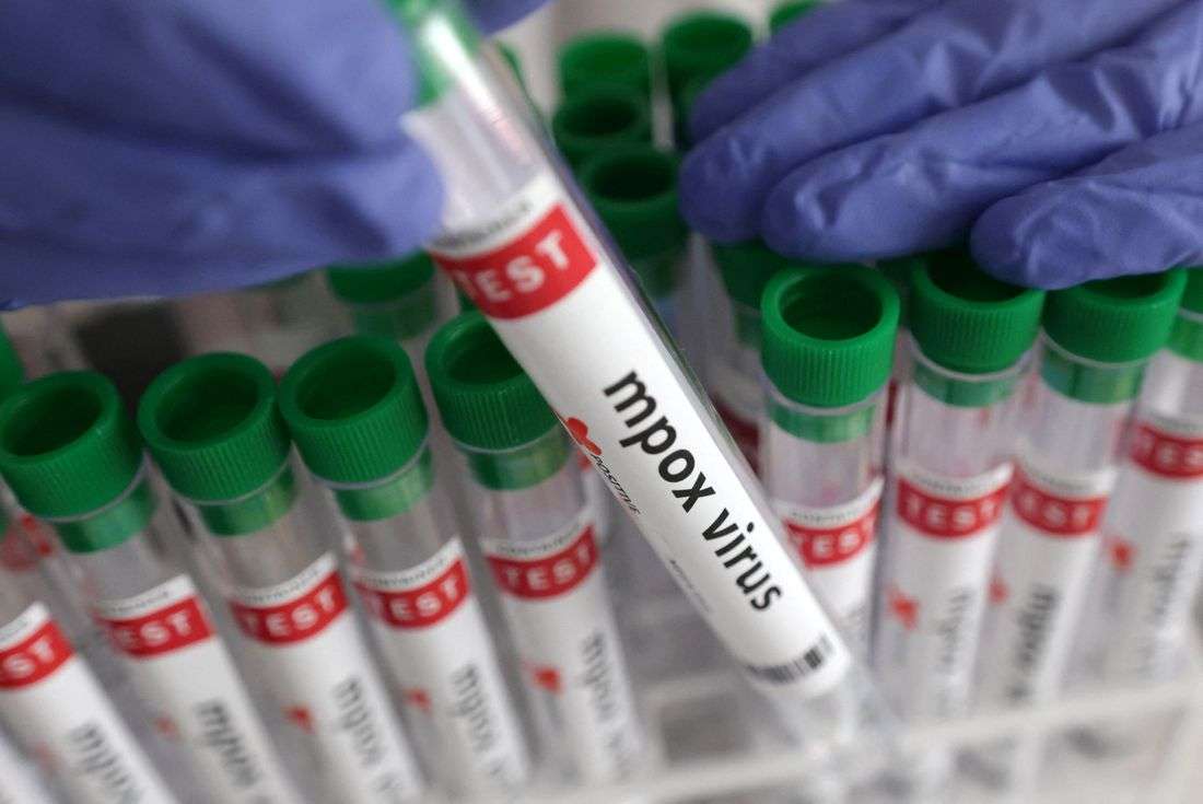 Mpox case confirmed in northeastern Congolese city at center of Ebola outbreak