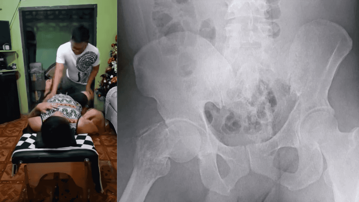Content creator dies of injuries from chiropractic session